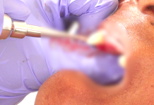 Tooth Decay, Gum Disease Cases Rise in Cape Coast Tooth Decay Gum Disease Cases Rise in Cape Coast