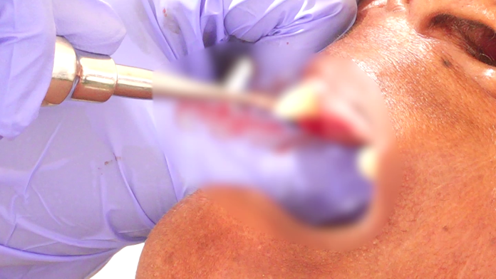 Tooth Decay Gum Disease Cases Rise in Cape Coast Tooth Decay Gum Disease Cases Rise in Cape Coast